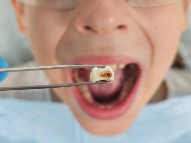 Best Emergency Dental Care for Abscessed Tooth in King, NC